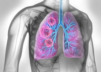 Lungekreftpasienter som ble behandlet med immunterapien Tecentriq (atezolizumab) etter operasjon og cellegift - såkalt adjuvant behandling - levde lengre uten at sykdommen kom tilbake enn de som kun fikk standardbehandling. Lungekreftpasienter som ble behandlet med immunterapien Tecentriq (atezolizumab) etter operasjon og cellegift - såkalt adjuvant behandling - levde lengre uten at sykdommen kom tilbake enn de som kun fikk standardbehandling.