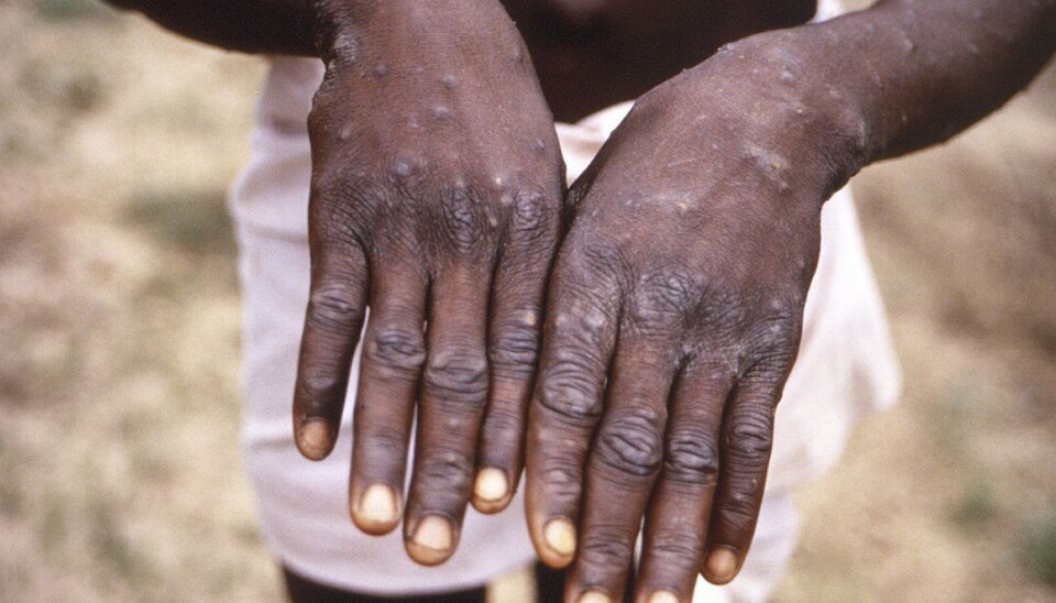 En kongolesisk mann viser fram hendene sine etter å ha blitt smittet av apekopper i 1997. I Afrika har det vært jevnlige utbrudd av sykdommen i flere tiår, men først nå, etter noen hundre tilfeller i vestlige land, har forskningen på sykdommen skutt fart.