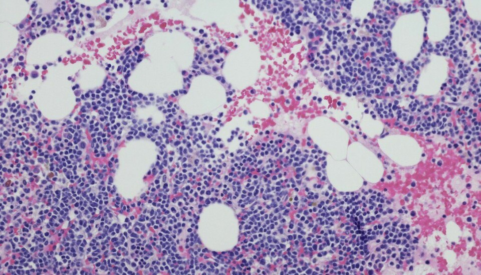 Å legge Sarclisa (isatuximab) - et CD38-rettet monoklonalt antistoff - til standardbehandlingen  gir dypere og lengre responser for nydiagnostiserte myelomatosepasienter. Bildet er tatt med mikrograf og viser myelomatoseceller tatt fra en benmargsbiopsi.