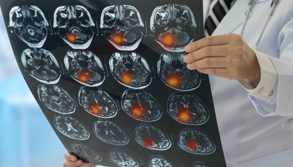 Norsk studie lot pasienter med hjernekreft evaluere sin egen livskvalitet
