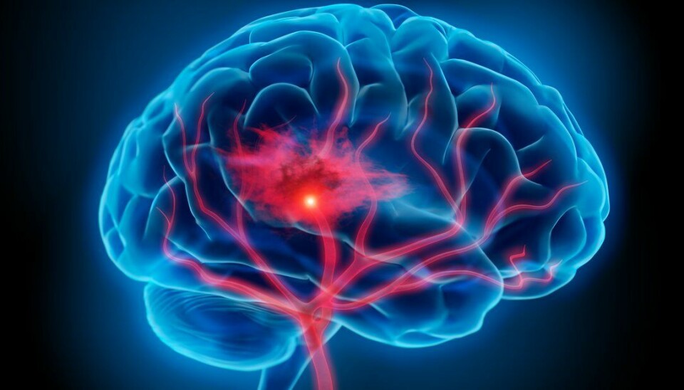 Blodfortynnende medisiner forbedrer prognosen for pasienter med middels risiko for hjerneslag. Sjansen blir derimot noe større for å få hjerneblødning.