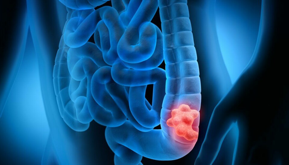 Pasienter med uhelbredelig tykktarmskreft som ble behandlet med cellegift og immunterapien Opdivo hadde signifikant lengre progresjonsfri overlevelse enn pasienter som bare ble behandlet med cellegift., viser METIMMOX-studien som nå er presentert på ASCO