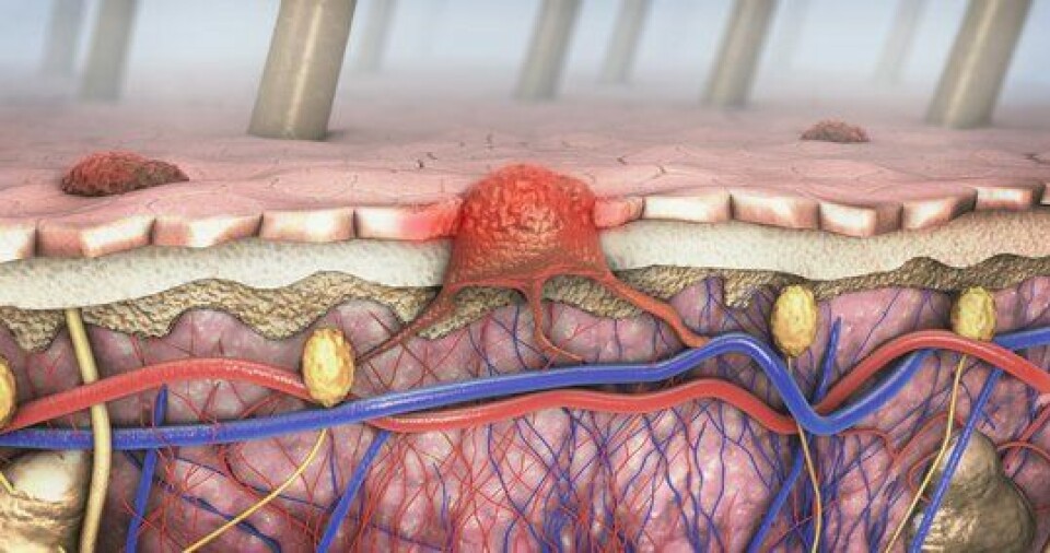 3d-illustrasjon av melanom som vokser inn i blodårene og lymfesystemet
        
      
      
        Melanon