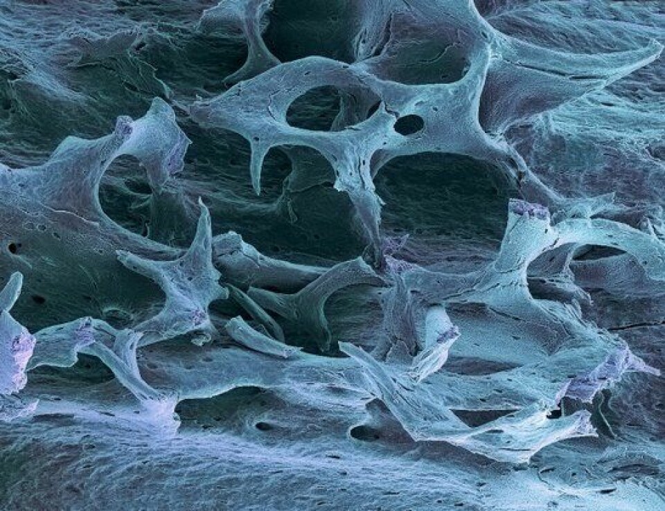 Porøst ben: Slik ser benstrukturen ut  ved osteoporose