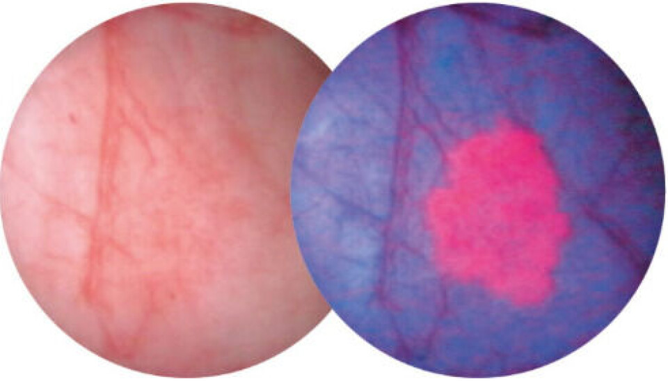 Ved bruk av Hexvix/ Cysview sammen med et blått lys på cystoskopet, vil forandringer i vevet vises i form av endret fargestruktur. Svulsten(e) vil da lyse rødt mot en blå bakgrunn, noe som gjør at kirurgene oppdager kreft som ikke er synlige med standardmetoden hvitt lys som vises i bildet til venstre.