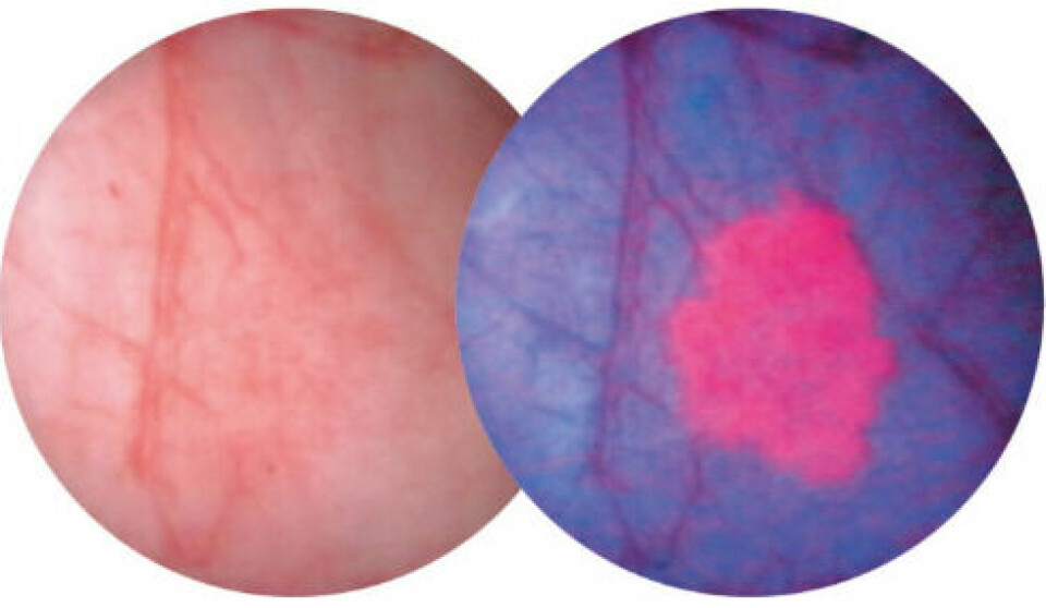 Ved bruk av Hexvix/ Cysview sammen med et blått lys på cystoskopet, vil forandringer i vevet vises i form av endret fargestruktur. Svulsten(e) vil da lyse rødt mot en blå bakgrunn, noe som gjør at kirurgene oppdager kreft som ikke er synlige med standardmetoden hvitt lys som vises i bildet til venstre.