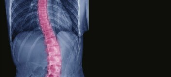 Ny studie vil se på nytt behandlingsalternativ for pasienter med deformitet i ryggen