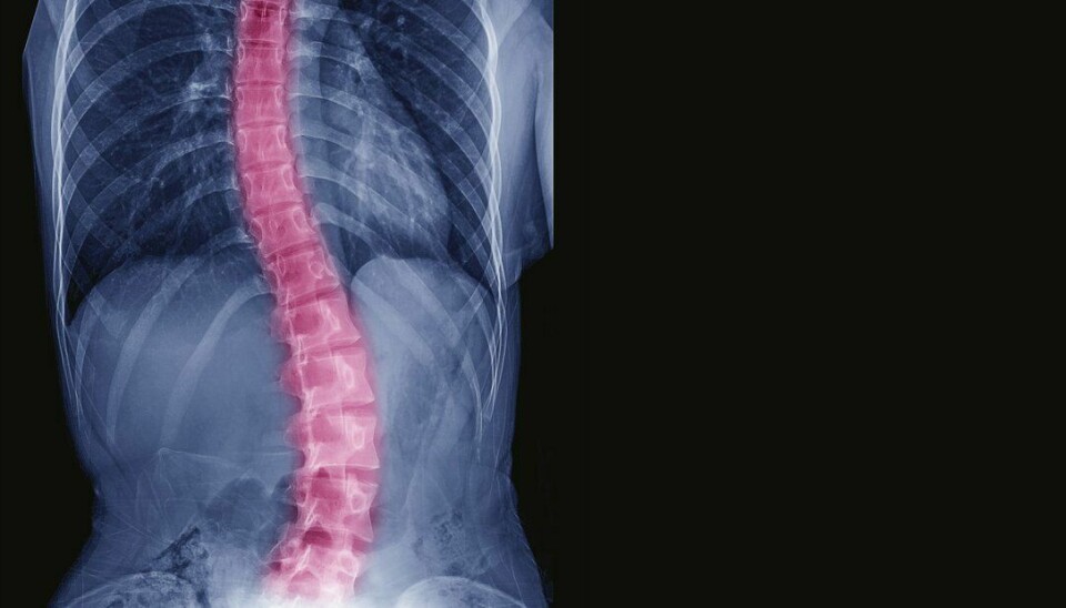 -Det er mange ting vi prøver å finne ut av i denne studien, men det går jo først og fremst ut på deformiteter i rygg hos voksne som må korrigeres mer enn 20 grader.