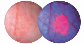 Ved bruk av Hexvix sammen med et blått lys på cystoskopet, vil forandringer i vevet vises i form av endret fargestruktur. Svulsten(e) vil da lyse rødt mot en blå bakgrunn, noe som gjør at urolgene oppdager kreft som ikke er synlige med standardmetoden hvitt lys som vises i bildet til venstre.