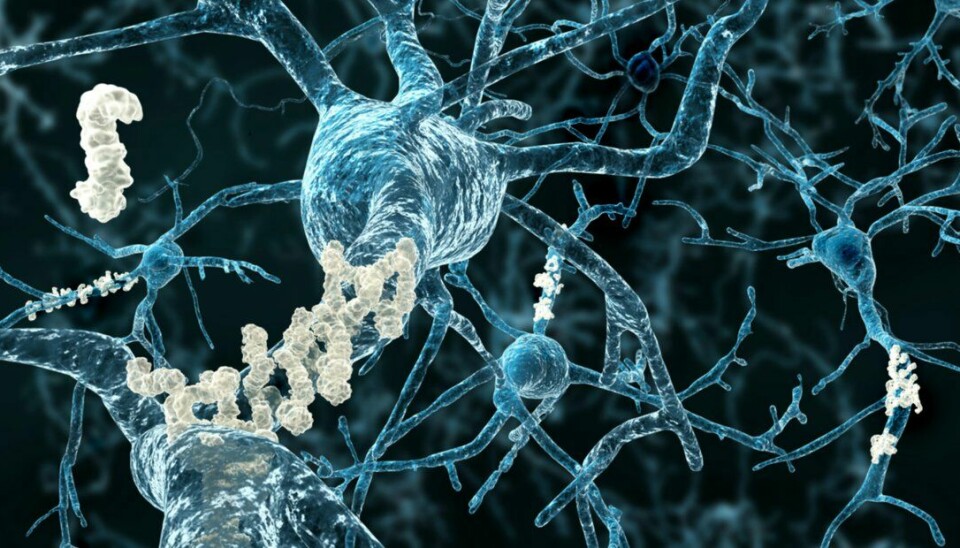 Illustrasjonen viser nevroner med amyloid plakk som dannes i hjernen til mennesker med Alzheimers sykdom. Nå har forskere funnet 13 hittil ukjente genvarianter som kan forårsake Alzheimers sykdom.