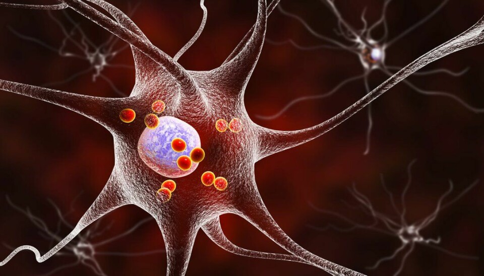 3D-illustrasjon viser nevroner som inneholder Lewy-legemer, små røde sfærer som er avleiringer av proteiner akkumulert i hjerneceller som forårsaker deres progressive degenerasjon