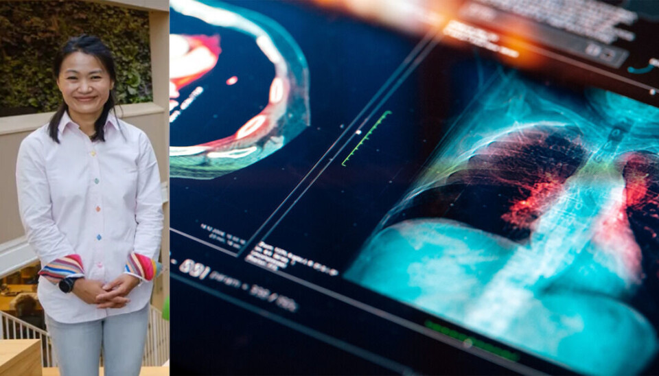 - Vi er veldig glad for at immunterapi blir tilgjengelig også for denne formen for lungekreft. Dagens beslutning betyr først og fremst at Tecentriq kan vurderes til alle pasienter med utbredt småcellet lungekreft i førstelinje, sier Anne Bee Hegge, konstituert medisinsk direktør i Roche Norge