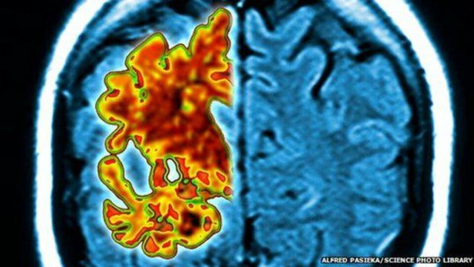 Blodprøve som kan diagnostisere Alzheimer er innen rekkevidde