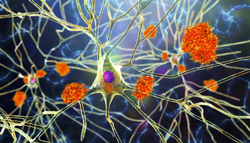 Alzheimers skyldes et protein kalt amyloid som danner unormale avsetninger på nevronene i hjernen til mennesker med Alzheimers. I tillegg til å bremse den kognitive nedgangen reduserte Lecanemab også dramatisk nivåer av beta-amyloid