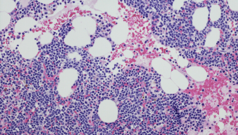 NY TYPE LEGEMIDDEL: Blenrep er det første legemiddelet i en ny klasse, et såkalt anti-BCMA, der cellegiften mafodotin er bundet til et monoklonalt antistoff. Bildet viser myelom neoplasma fra benmargsbiopsi. FOTO: GettyImages