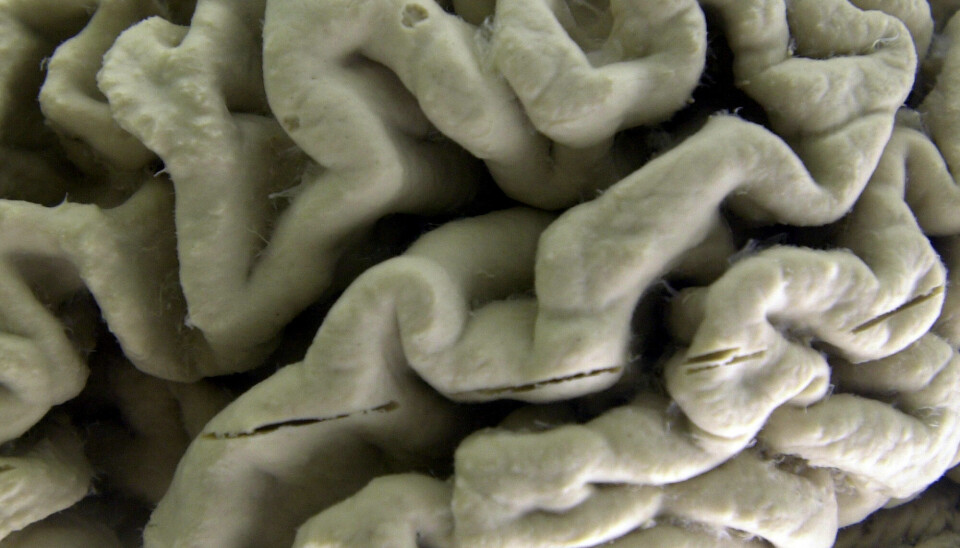 Leqembi virker gjennom å fjerne avleiringer av et protein som kalles betaamyloid i hjernen, et av kjennetegnene ved Alzheimers sykdom. Bildet viser en hjerne rammet av sykdommen, utstilt på et museum for nevroanatomi i USA. Foto: David Duprey / AP / NTB