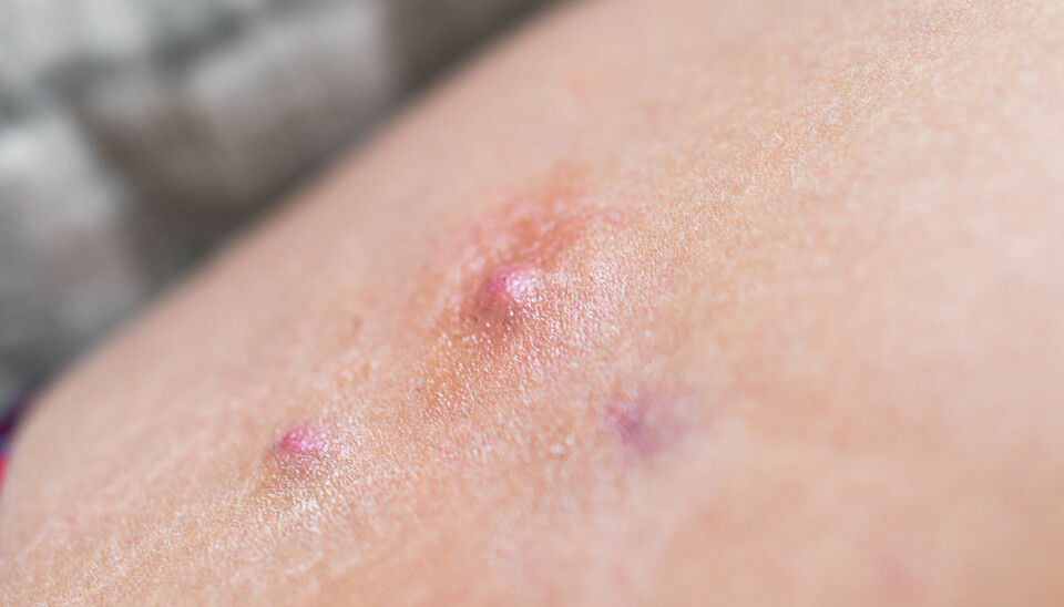 Bimekizumab viser vedvarende effekt og symptomforbedring hos pasienter med den inflammatoriske hudsykdommen Hidrosadenitt.