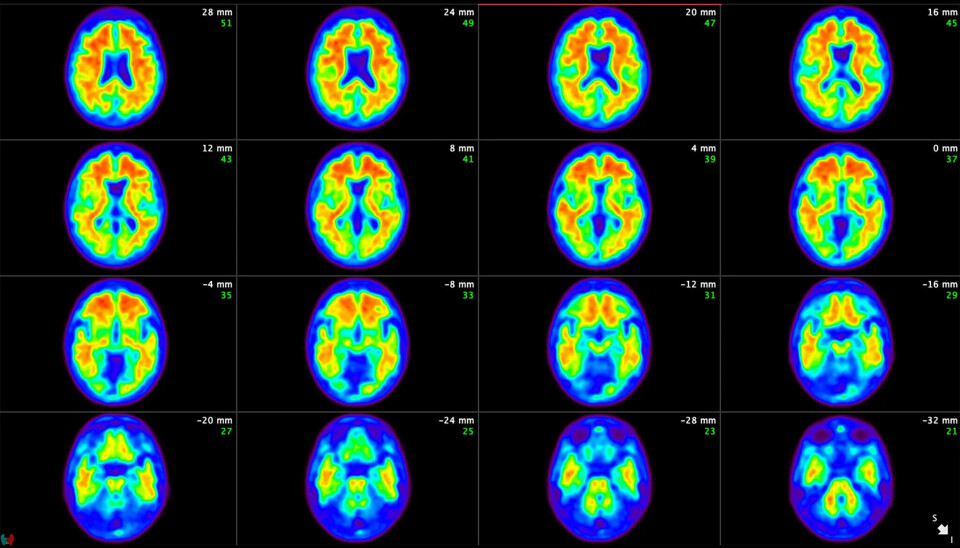 Hjerneskanninger fra en pasient i kliniske forsøk med donanemab viste at amyloid plakk ble fjernet fra pasientens hjerne når pasienene fikk donanemab.