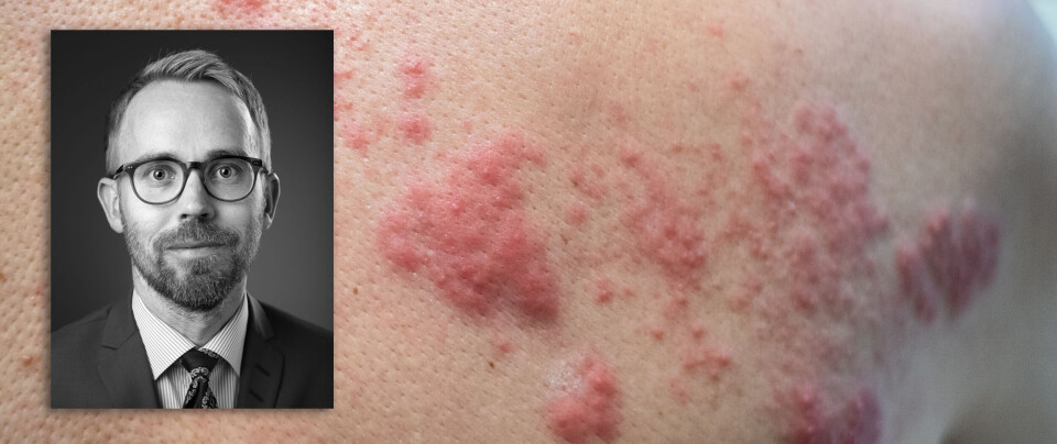 INGEN STOR ENDRING: Dermatolog og OUS-overlege Olav Sundnes synes de nye Rinvoq-dataene er interessante. Samtidig er han ærlig på at hudlegene er såpass bundet til legemiddelanbudene at resultatene ikke vil ha stor påvirkning på klinisk praksis.