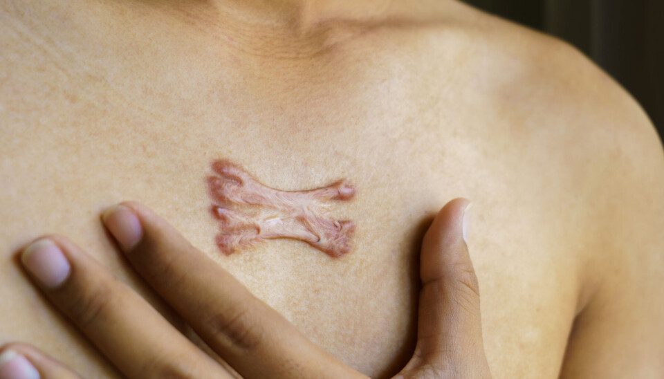 Bildert viser et keloid-arr.