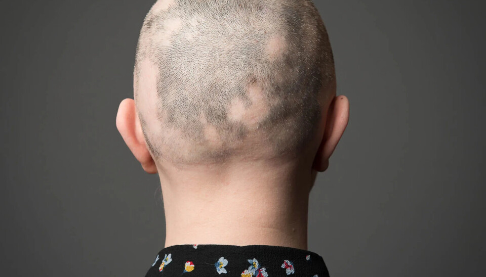 Alopecia areata kan ha stor psykososial innvirkning på pasienter, og mange opplever depresjon og angst som følge av hårtapet. Alvorlighetsgraden av sykdommen blir ofte undervurdert, noe som kan hindre pasienter i å få tilgang til effektiv behandling.