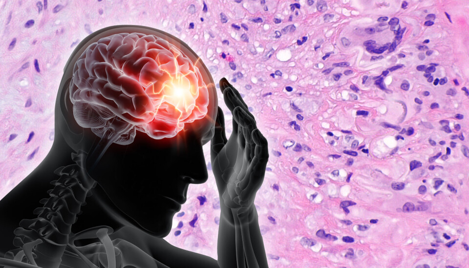 ALVORLIG: – Kjempecellearteritt er en alvorlig inflammatorisk sykdom som, hvis den ikke behandles, kan føre til alvorlige komplikasjoner som blindhet, slag eller aortaaneurisme, sier professor Wolfgang Schmidt ved Waldfriede Hospital i Berlin